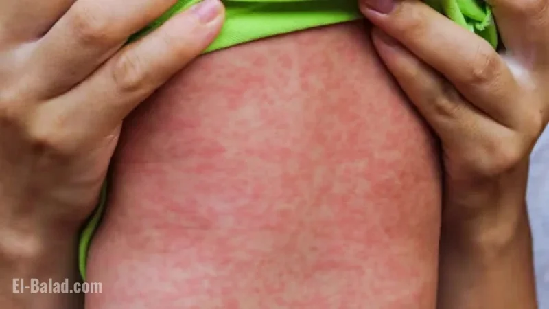 Measles Outbreak in Alberta Claims Life of Premature Infant