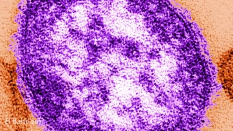 Albertan Succumbs to Measles Infection