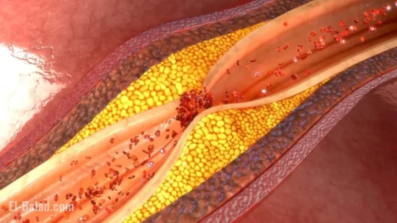 Amgen’s Repatha Reduces Heart Attack Risk by 36%