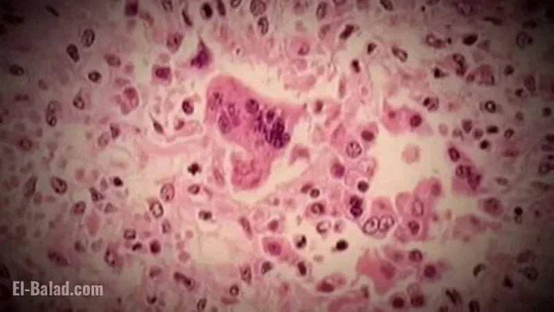 Canada Loses Measles-Free Status