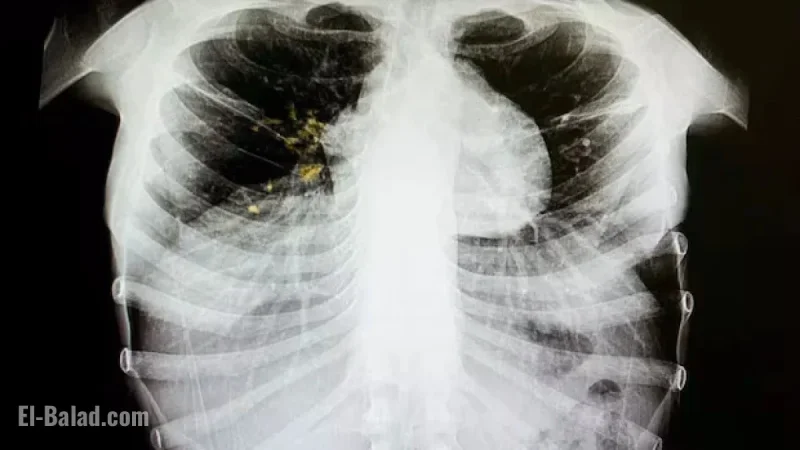 Primary Care Alberta Declares Tuberculosis Outbreak in Edmonton’s Inner City