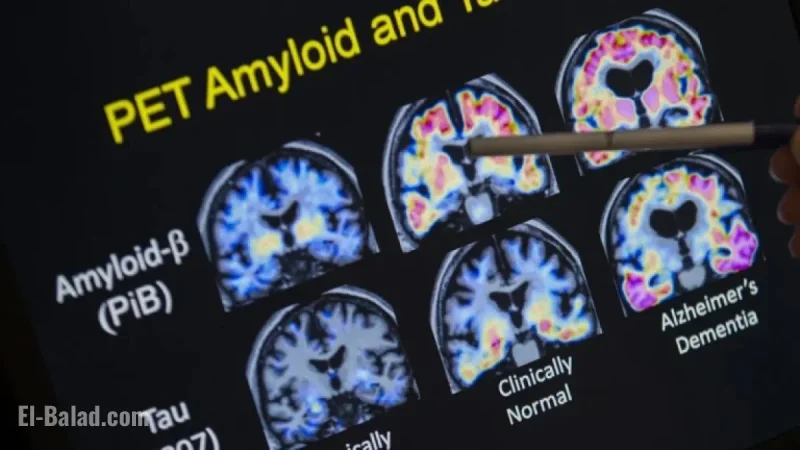J&J’s Alzheimer’s Drug Posdinemab Fails Crucial Trial