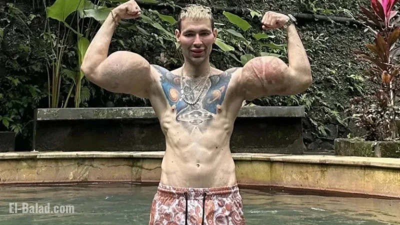 Influencer Refutes Claims of Near-Fatal Necrosis and Arm Amputation