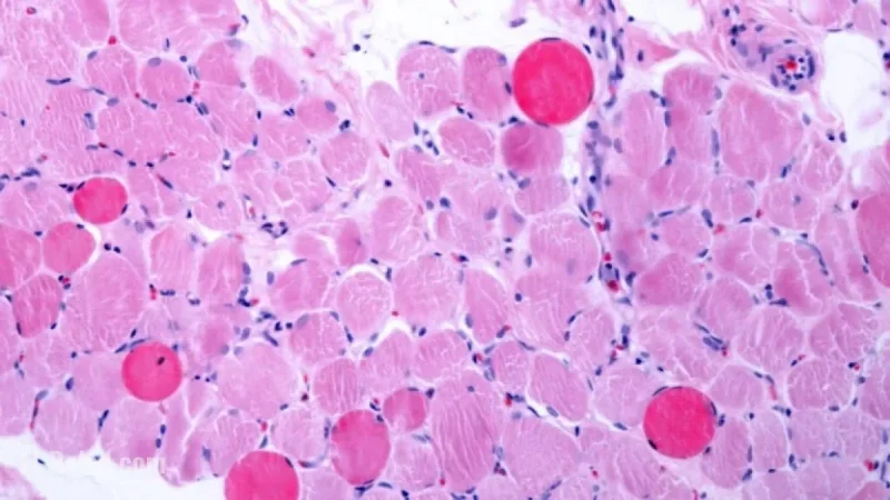 Capricor Cell Therapy Boosts Heart and Muscle Function in Duchenne Patients