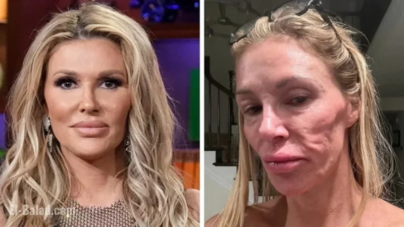 Brandi Glanville Diagnosed with Facial Disfigurement After Suspected Parasite