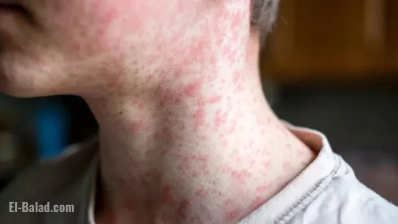 Measles Outbreak Confirmed: 6 Cases in Quebec, Including Greater Montreal