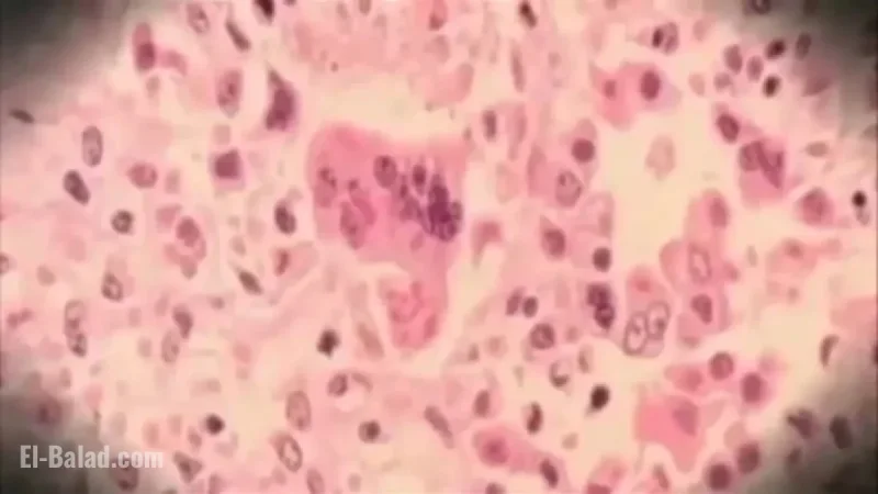 Measles Exposure Alert Issued by New Jersey Health Department at Newark Airport