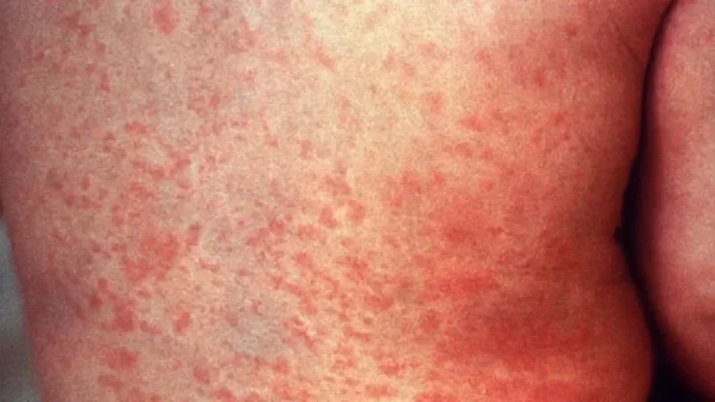 Measles Detected in Federal Detainee in Pinal County, Officials Report