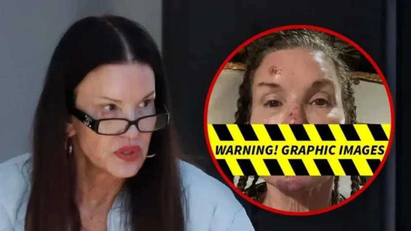 Janice Dickinson Seen Post-Accident, Reveals Alleged Reality Show Injuries