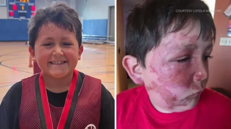 Plainfield Boy Injured by TikTok Needoh Cube Trend; Loyola Warns Public