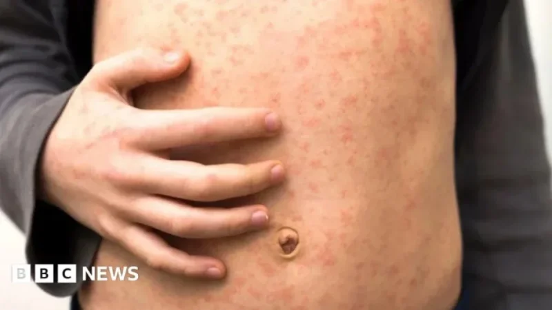 Measles Outbreak Rapidly Spreads Across Multiple London Schools