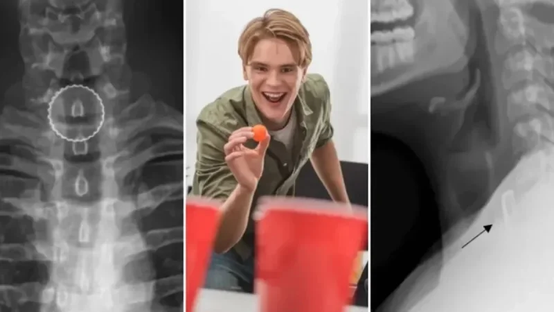 19-Year-Old Undergoes Surgery After Unusual Beer Pong Injury