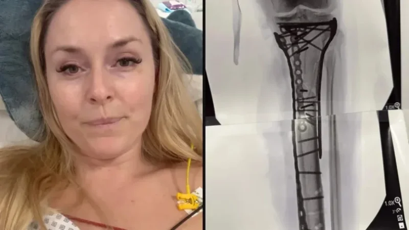 Lindsey Vonn’s Injury: Recovery Timeline and Future Skiing Prospects