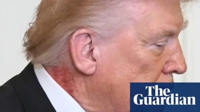 White House: Trump’s Neck Rash Results from Preventative Skin Treatment