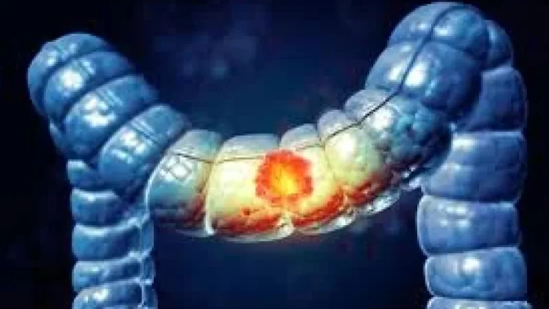 Cancer Colorectal at an Inflection Point as Young Adult Deaths Rise