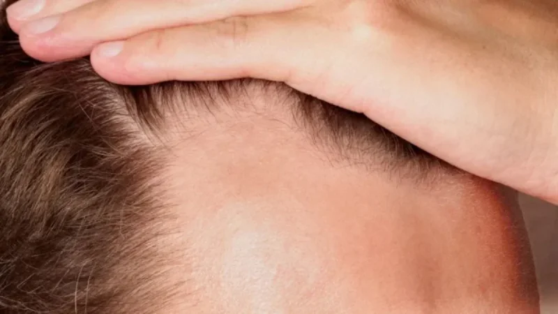 Oral Minoxidil Pill Proves Effective in Major Hair Loss Trial