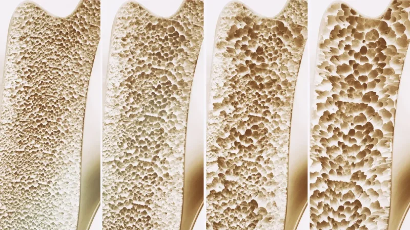 Canada Researchers Find Little Benefit in 69 Calcium Supplements Trials