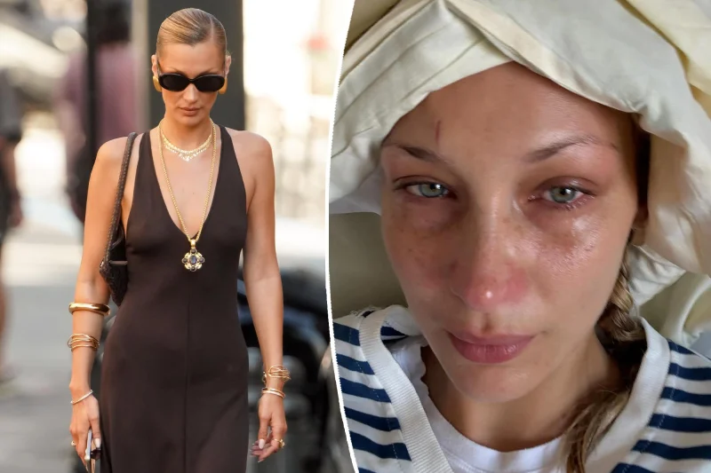 Bella Hadid says severe Lyme disease flare-up hit on June 25