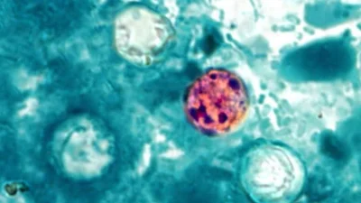 Cyclosporiasis cases surge in Michigan as Ohio reports 177 infections