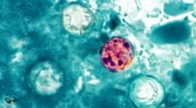 CDC tracks 34-state Explosive Diarrhea Outbreak with nearly 7,000 cases