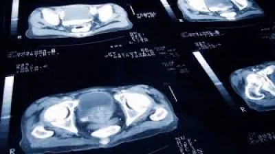Prof Hashim Ahmed backs 10-year NHS study on Focal Therapy For Prostate Cancer