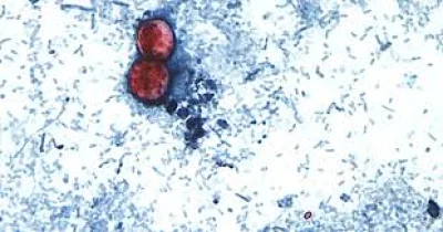 Federal health officials investigate 72 New Cyclospora Outbreak illnesses