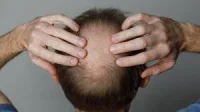 Researchers link hair loss risk to Glp-1 Receptor Agonist drugs