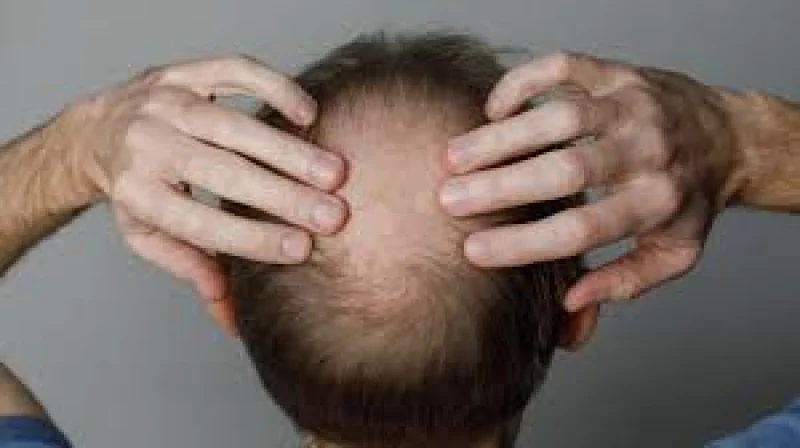 Researchers link hair loss risk to Glp-1 Receptor Agonist drugs