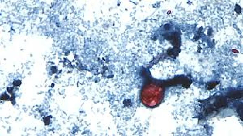 Michigan health officials report first two deaths in Michigan Cyclospora Outbreak Cases