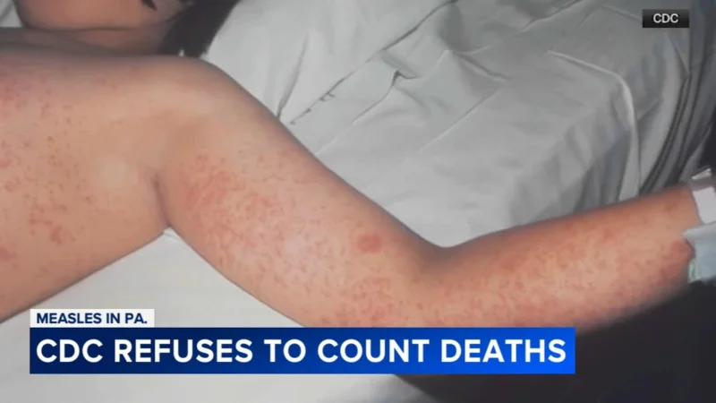 CDC delays 2 Pennsylvania deaths in Measles Outbreak count