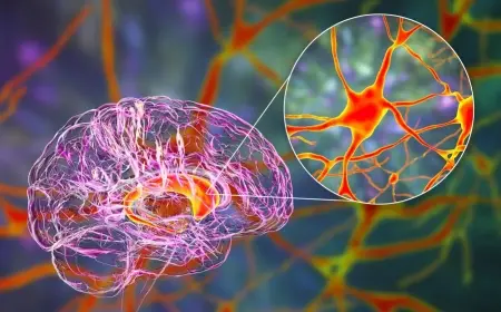 Landmark Breakthrough: Gene Therapy Slows Huntington's Disease Progression, Raising Hope for Millions