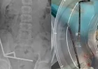 Surgeons Extract Dozens of Magnets from Teen’s Stomach