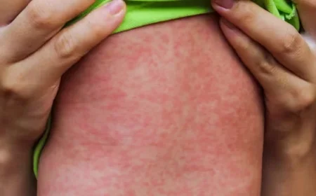 Measles Outbreak in Alberta Claims Life of Premature Infant