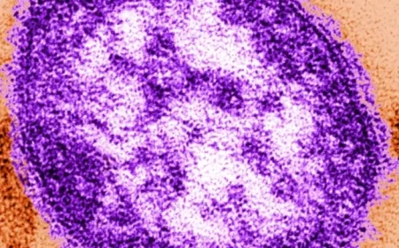 Albertan Succumbs to Measles Infection