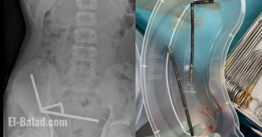 Surgeons Extract Dozens of Magnets from Teen’s Stomach