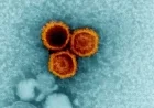 Study Links Common Epstein-Barr Virus to Lupus Development
