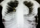 Primary Care Alberta Declares Tuberculosis Outbreak in Edmonton’s Inner City