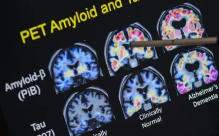 J&J’s Alzheimer’s Drug Posdinemab Fails Crucial Trial