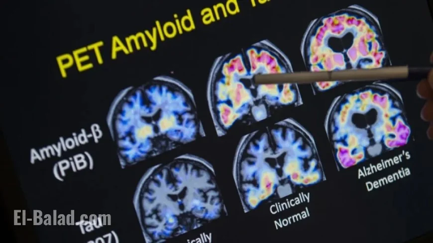 J&J’s Alzheimer’s Drug Posdinemab Fails Crucial Trial