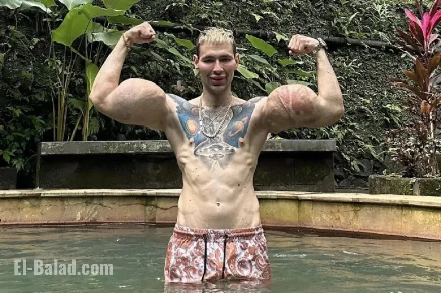 Influencer Refutes Claims of Near-Fatal Necrosis and Arm Amputation