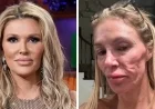 Brandi Glanville Diagnosed with Facial Disfigurement After Suspected Parasite