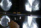 AI Companies Assert Mammograms Detect Various Health Risks