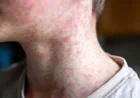 Measles Outbreak Confirmed: 6 Cases in Quebec, Including Greater Montreal