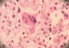 Measles Exposure Alert Issued by New Jersey Health Department at Newark Airport