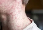 Measles Warning Issued at Major Australian Airport