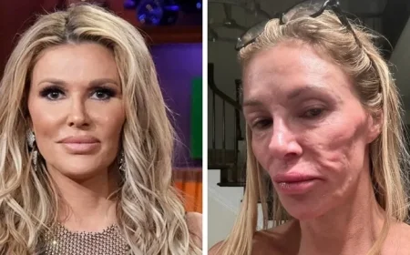 Brandi Glanville Diagnosed with Facial Disfigurement After Suspected Parasite