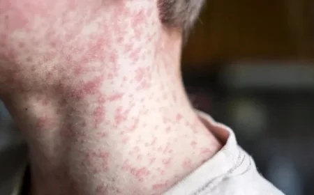 Measles Warning Issued at Major Australian Airport