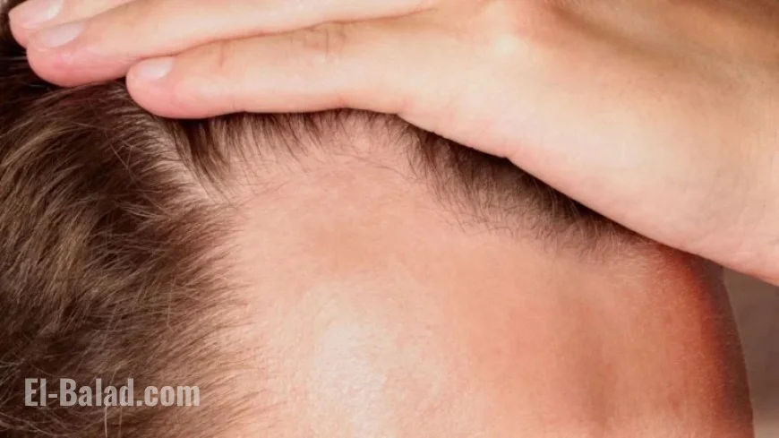 Baldness Drug Trials Show 539% Hair Growth Increase