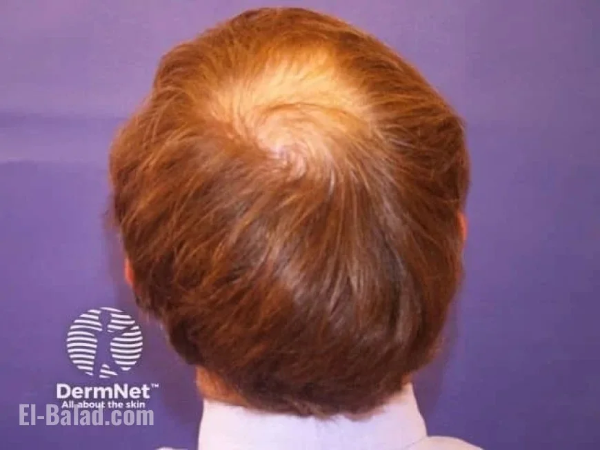 Clascoterone 5% Achieves Promising Phase 3 Hair Growth Results