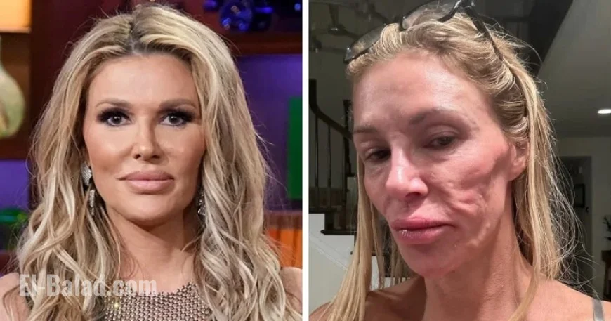 Brandi Glanville Diagnosed with Facial Disfigurement After Suspected Parasite